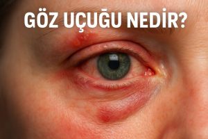 Göz Uçuğu Nedir?